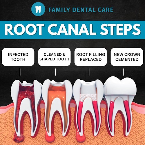 family dental root canal